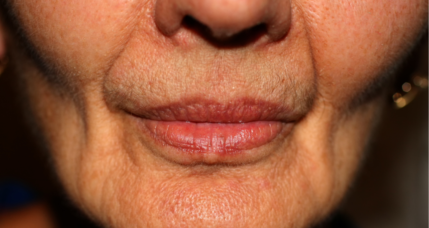 Cheek Augmentation